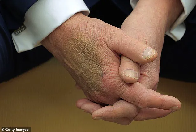 Trump Defies Medical Advice, Takes High-Dose Aspirin Daily: 'They Say Aspirin Is Good for Thinning Out the Blood'—WSJ Interview