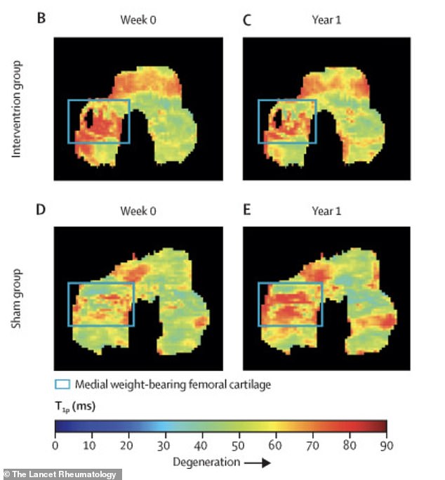 Stanford Study: Simple Walking Angle Change Alleviates Osteoarthritis Pain