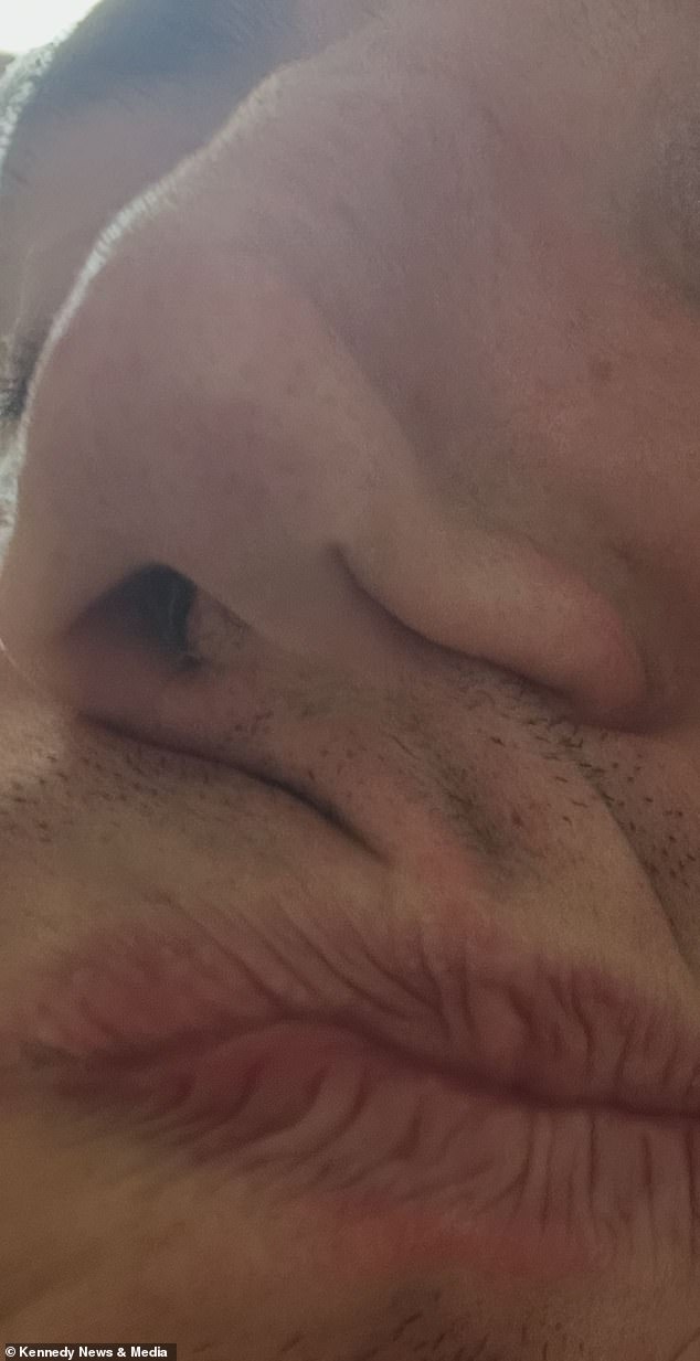Man suffers permanent nose collapse after spending £35,000 on cocaine over 15 years